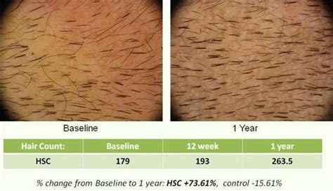 Histogen's Hair Stimulating Complex (HSC) .